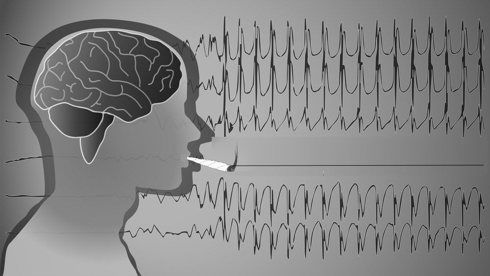 Epileptic Seizures Drop By 86 With Whole Plant Cannabis Extracts In   3743 4bIX Epilipticcannabistreatment 