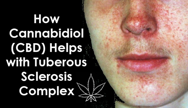 CBD for Tuberous Sclerosis Complex