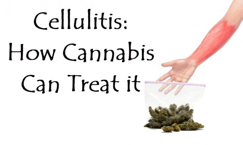 cannabis for cellulitis