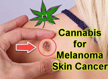 Medical Cannabis for Melanoma Skin Cancer