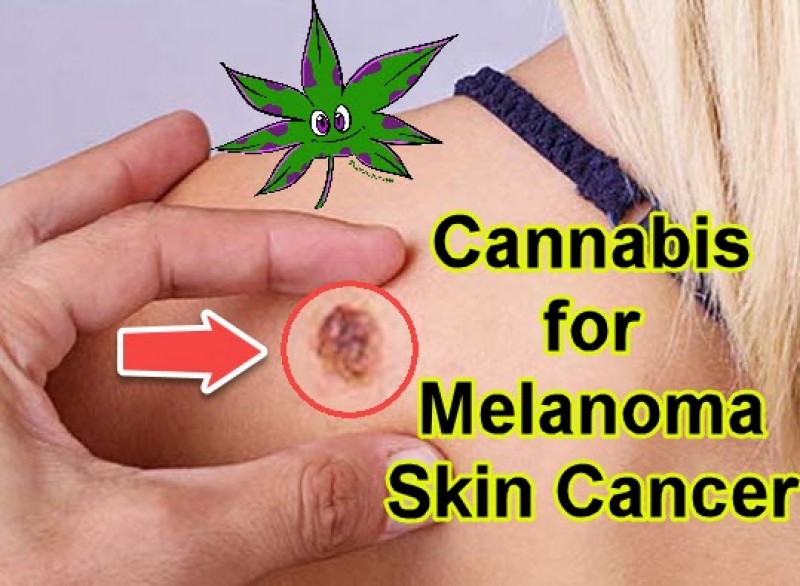cannabis melanoma