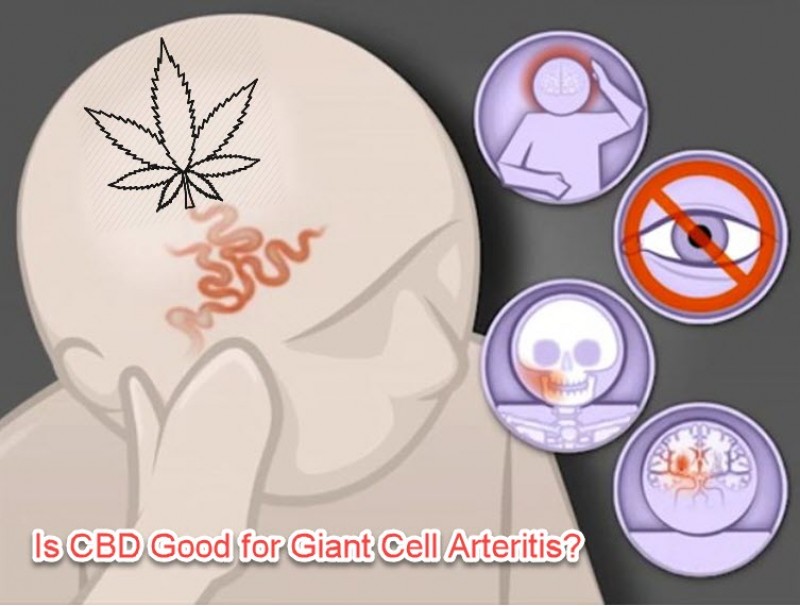 cbd giant cell artertisits