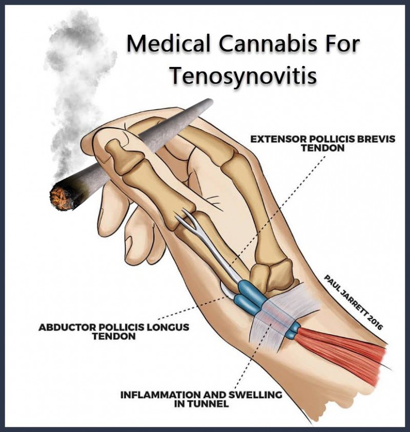 cannabis for tenosynovitis