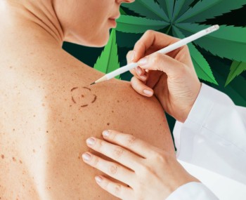 Melanoma Diagnosis is Skyrocketing and Cannabis May Now Be Part of a Treatment Solution for Many Patients