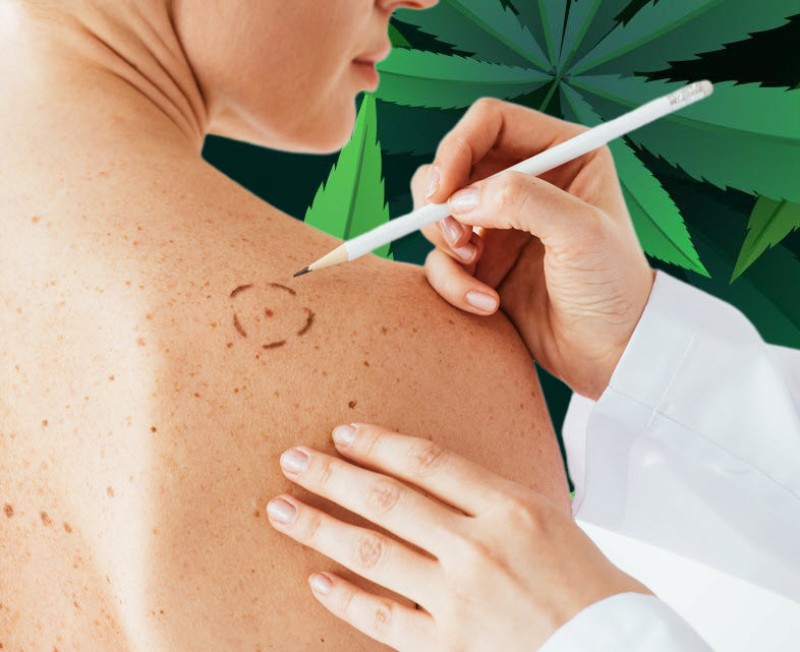 melanoma skin cancer cannabis