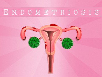 Why Weed is the Best Thing That's Happened to Endometrosis Patients in the Last 50 Years