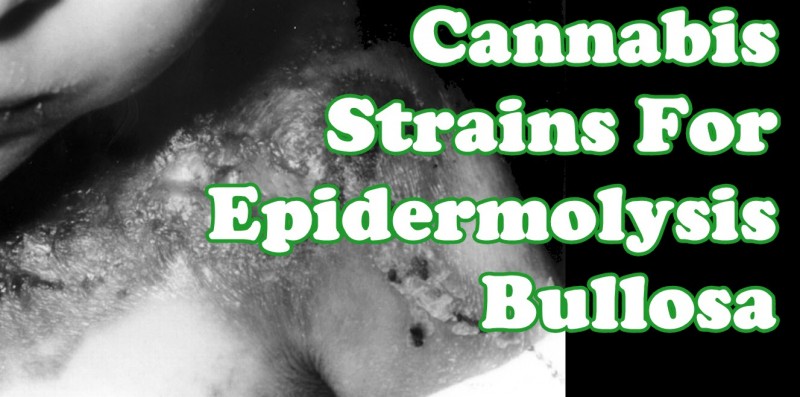 cannabis epidmolysis bullosa