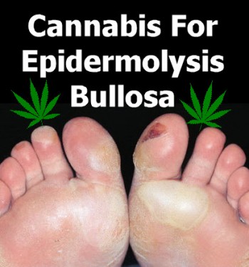 Cannabis For Epidermolysis Bullosa