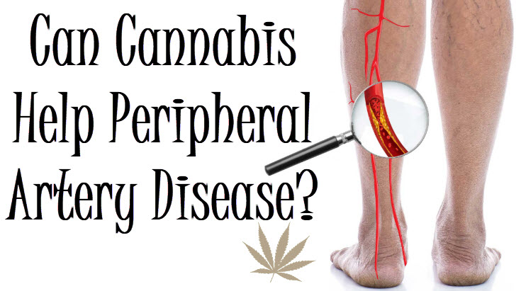 Can Cannabis Help Peripheral Artery Disease 