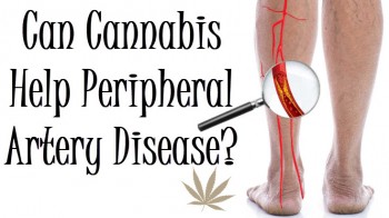 Can Cannabis Help Peripheral Artery Disease?