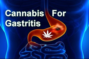 Cannabis for Gastritis