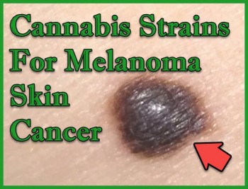 Cannabis Strains For Melanoma Skin Cancer