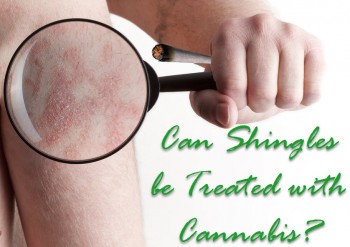 Can Shingles be Treated with Cannabis?