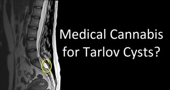 Medical Cannabis for Tarlov Cysts?