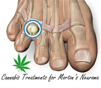 Cannabis Treatments for Morton’s Neuroma