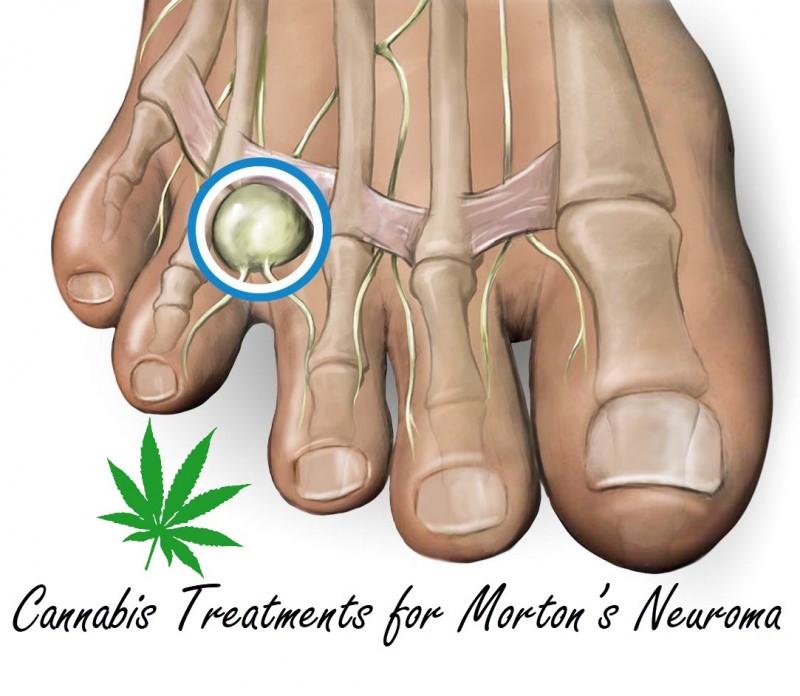 cannabis for morton's neuroma