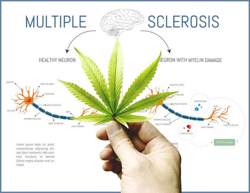 cannabis for MS