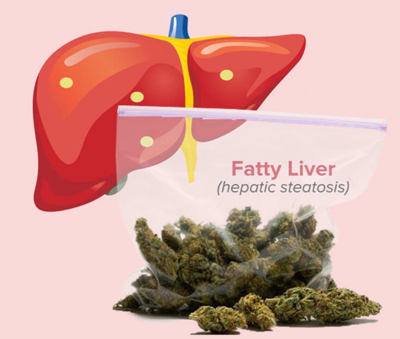 fatty liver disease and cannabis