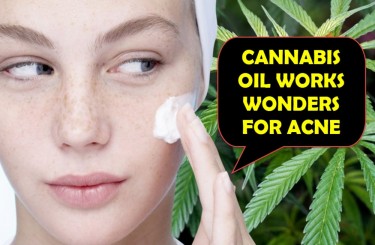 CANNABIS OIL FOR ACNE