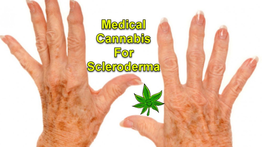 MARIJUANA FOR SCLERODERMA