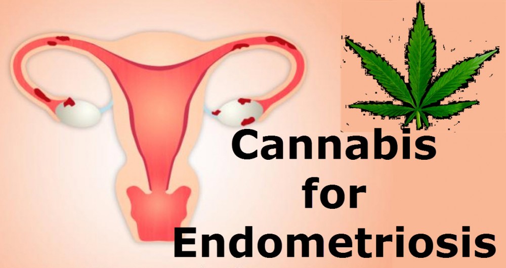 CANNABIS FOR ENDOMETROSIS