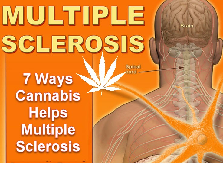 CANNABIS FOR MS