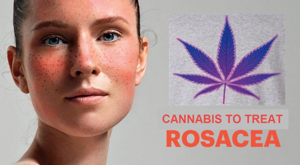 CBD CANNABIS FOR ROSACEA