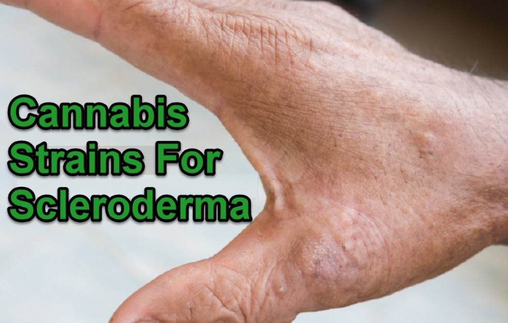 CANNABIS FOR SCLERODERMA