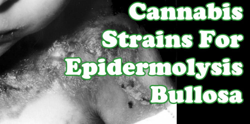 CANNABIS STRAINS FOR EPID BULLOSA