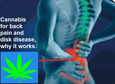 CANNABIS FOR DISC DISEASE