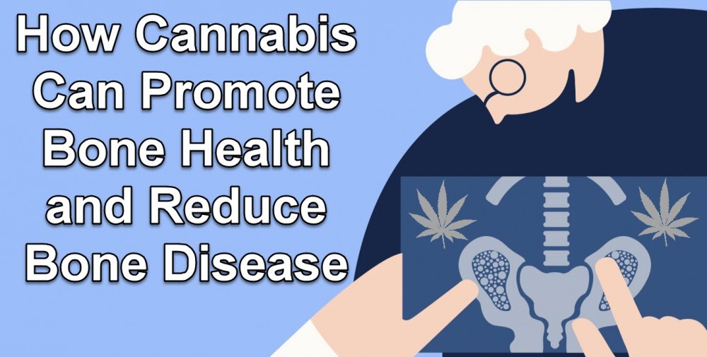 CANNABIS PROMOTES BONE HEALTH