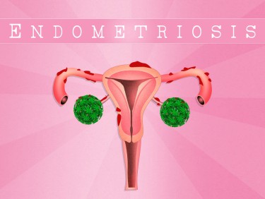 cannabis for endometriosis