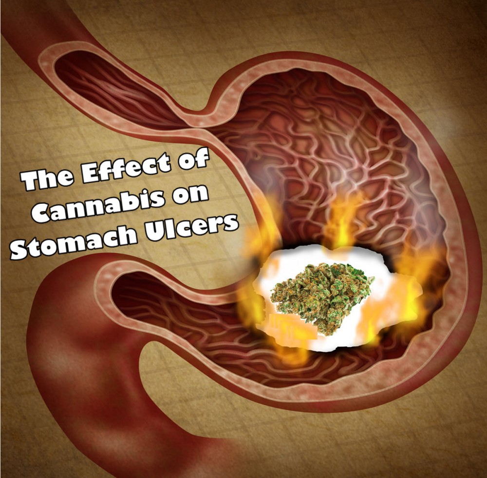 cannabis for ulcers