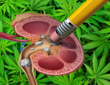 cannabis kidney stone study
