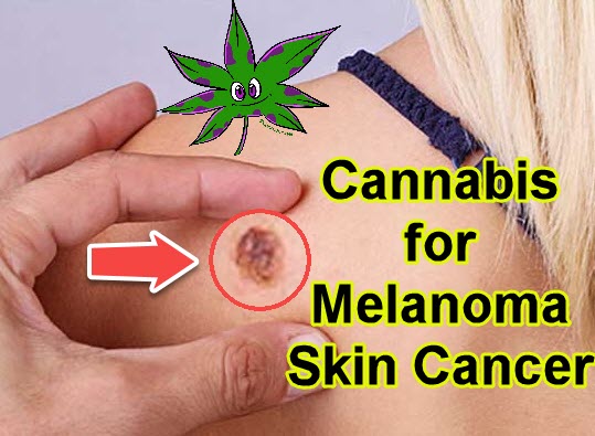 CANNABIS STRAINS FOR MELANOMA