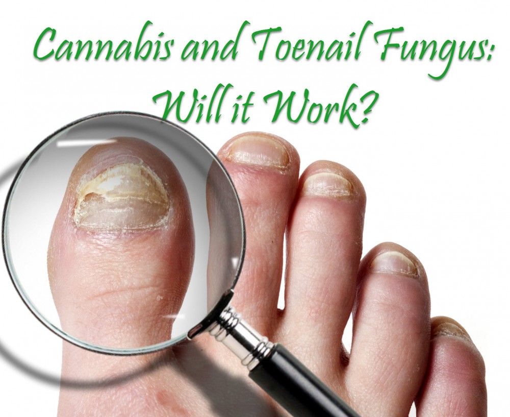 CANNABIS FOR TOENAIL FUNGUS