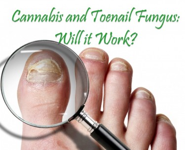 CBD FOR TOENAIL FUNGUS