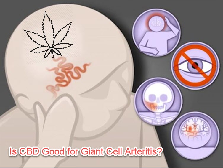 cbd for giant cell artertitis