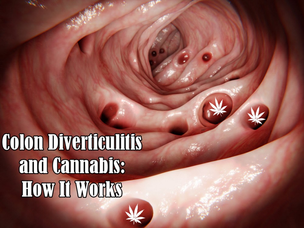 COLON DIVERTICULITIS AND CANNBIS