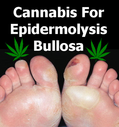 cannabis for epidermolys