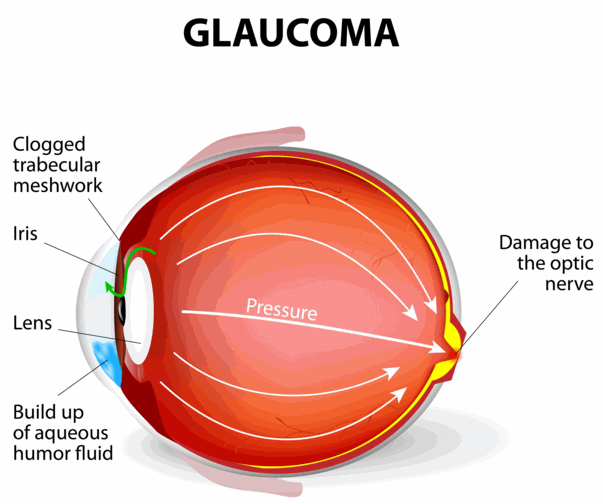 glaucoma and cannabis