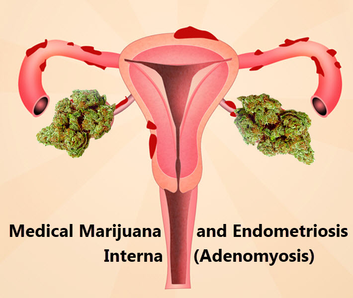 MARIJUANA FOR ENDOMETROSIS INTERNA