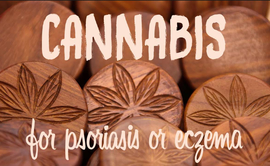 CANNABIS CREAMS AND PSORISIS