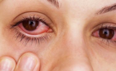 STONER RED EYE AND HOW TO DEAL