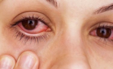 MARIJUANA RED EYE EXPLAINED