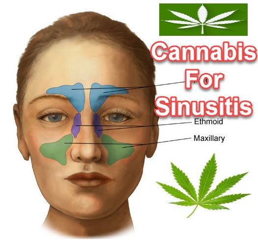 CANNABIS FOR SINUSITUS